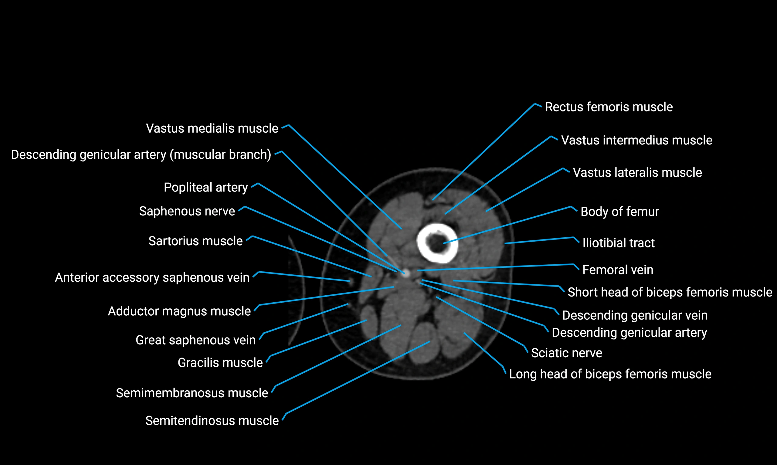 CT lower limb axial cross sectional anatomy labelled image 62 (2).webp